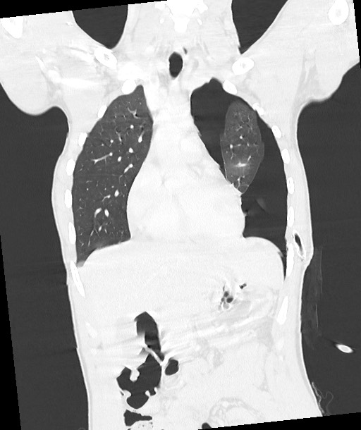 Arrow injury to the chest (Radiopaedia 85367-100975 Coronal lung window 62).jpg