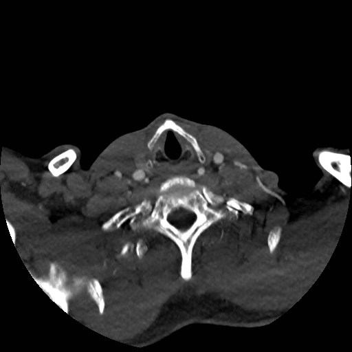 Artery of Percheron infarct (Radiopaedia 48088-52894 A 41).jpg