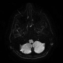 File:Artery of Percheron infarct (Radiopaedia 48088-52928 Axial DWI 6).jpg