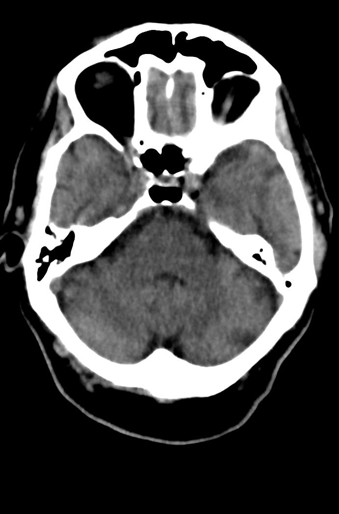 Artery of Percheron infarction (Radiopaedia 80613-94202 Axial non-contrast 59).jpg