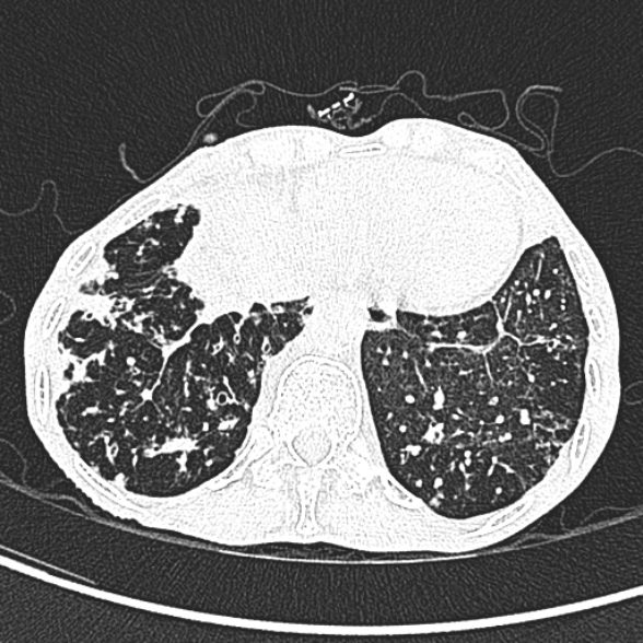File:Aspergilloma- with Monod sign (Radiopaedia 44737-48532 Axial lung window 241).jpg