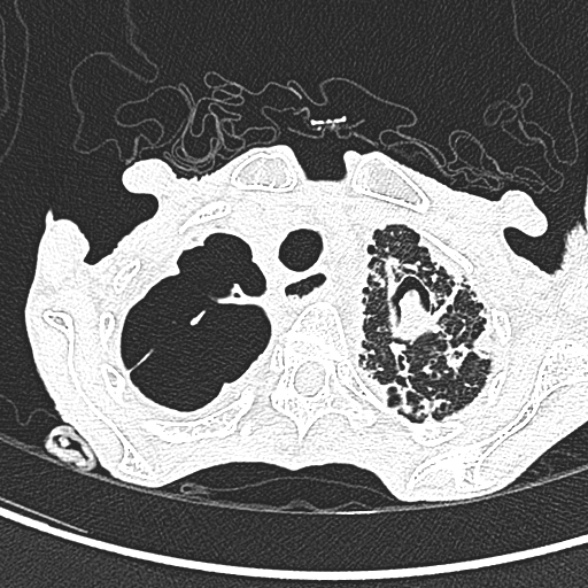 Aspergilloma- with Monod sign (Radiopaedia 44737-48532 Axial lung window 49).jpg