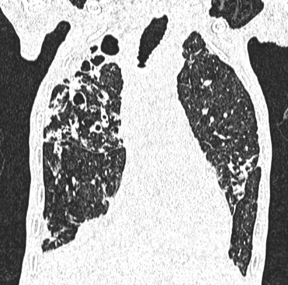 Aspergilloma- with Monod sign (Radiopaedia 44737-48532 Coronal lung window 208).jpg
