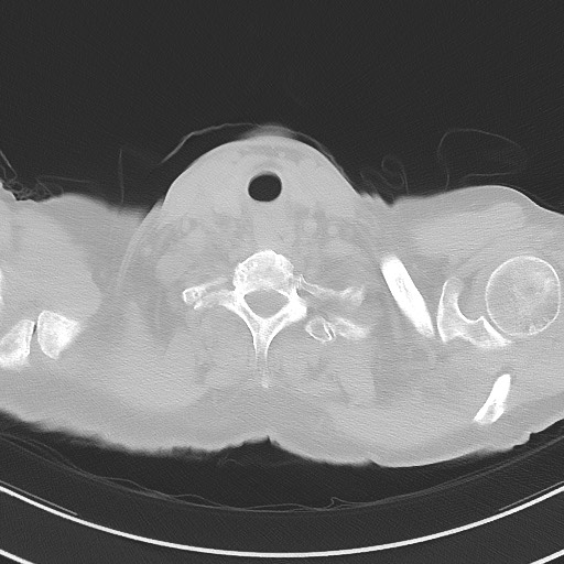 Aspergilloma on background pulmonary fibrosis (Radiopaedia 60942-68757 A 1).jpg