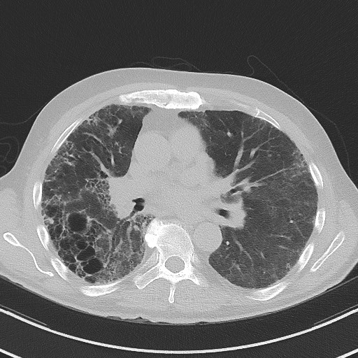 Aspergilloma on background pulmonary fibrosis (Radiopaedia 60942-68757 A 29).jpg