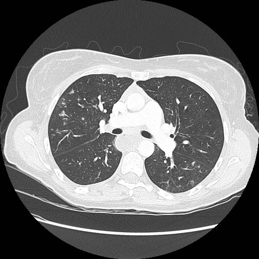 Aspiration pneumonia secondary to laparoscopic banding (Radiopaedia 18345-18183 lung window 45).jpg