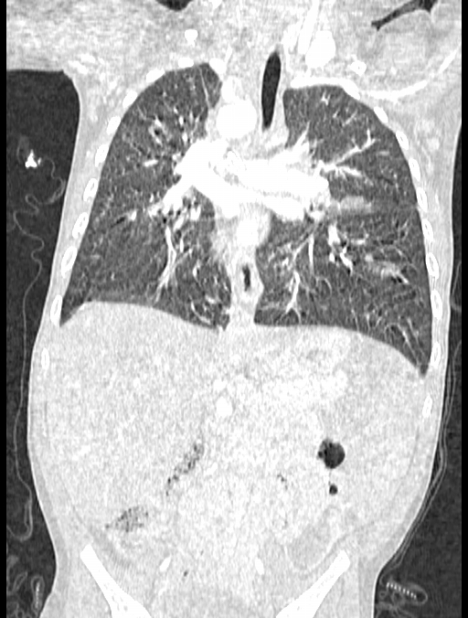 Asplenia syndrome (Radiopaedia 73083-83792 Coronal lung window 78).jpg