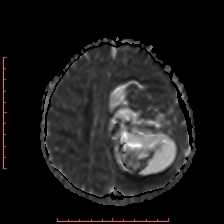 Astroblastoma (Radiopaedia 74287-85162 Axial ADC 47).jpg