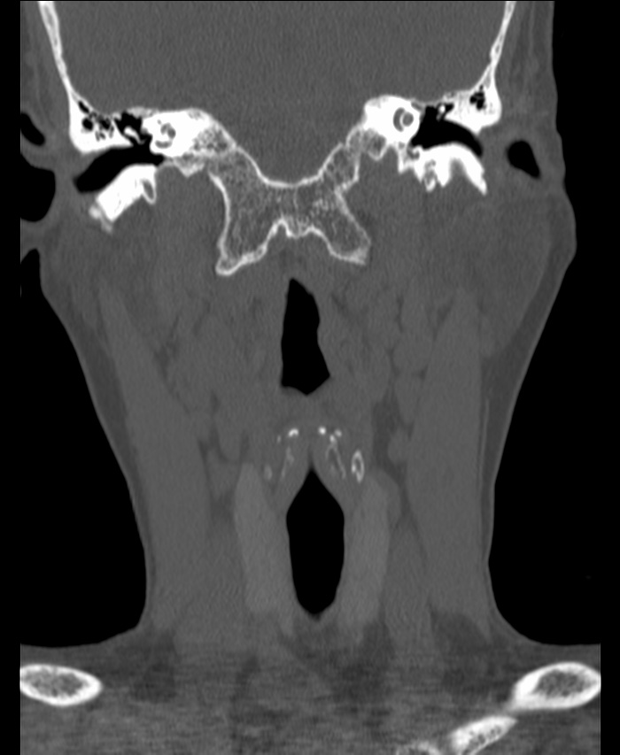 Atlanto-occipital assimilation with basilar invagination (Radiopaedia 70122-80188 Coronal bone window 42).jpg