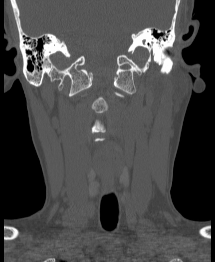 Atlanto-occipital assimilation with basilar invagination (Radiopaedia 70122-80188 Coronal bone window 64).jpg