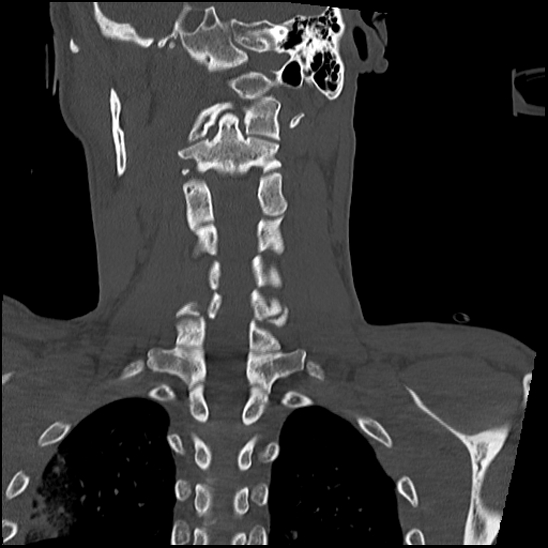 Atlanto-occipital dissociation (Traynelis type 1), C2 teardrop fracture, C6-7 facet joint dislocation (Radiopaedia 87655-104061 Coronal bone window 43).jpg