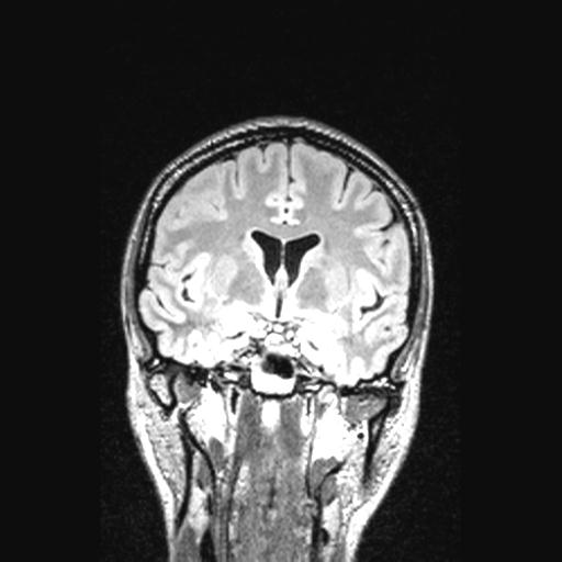 File:Atretic encephalocoele with inferior vermis hypoplasia (Radiopaedia 30443-31108 Coronal FLAIR 107).jpg