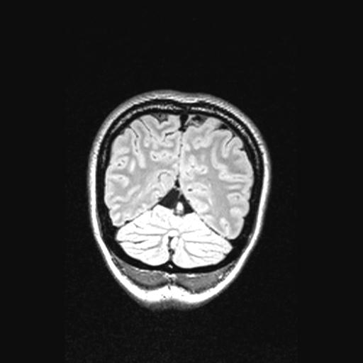 Atretic encephalocoele with inferior vermis hypoplasia (Radiopaedia 30443-31108 Coronal FLAIR 38).jpg