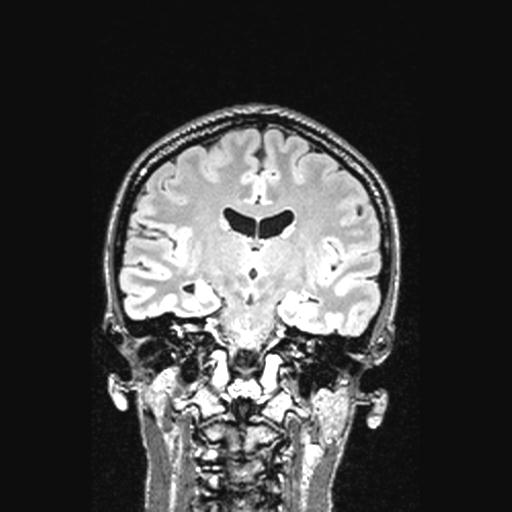 Atretic encephalocoele with inferior vermis hypoplasia (Radiopaedia 30443-31108 Coronal FLAIR 92).jpg