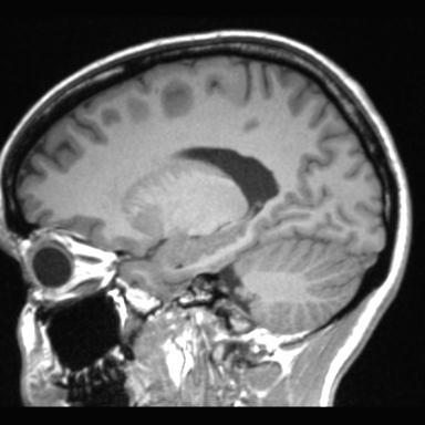 File:Atretic encephalocoele with inferior vermis hypoplasia (Radiopaedia 30443-31108 Sagittal T1 47).jpg