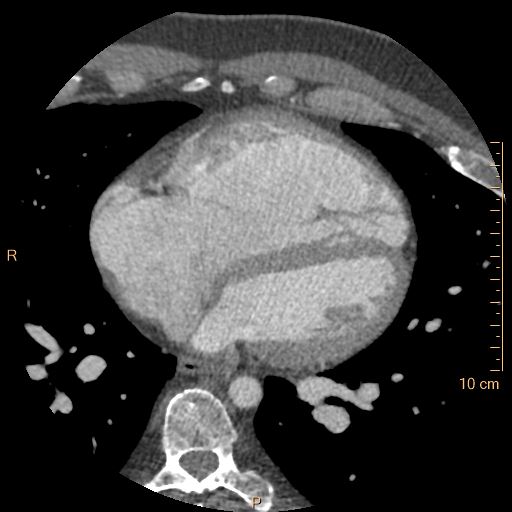 File:Atrial septal defect (upper sinus venosus type) with partial anomalous pulmonary venous return into superior vena cava (Radiopaedia 73228-83961 A 166).jpg