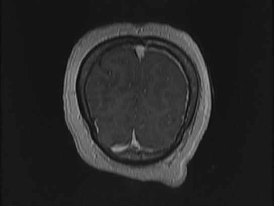 File:Atypical meningioma (Radiopaedia 62985-71406 Coronal T1 C+ 119).jpg
