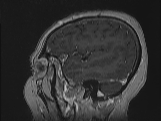 Atypical meningioma (Radiopaedia 62985-71406 Sagittal T1 C+ 12).jpg