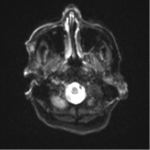 Atypical meningioma (WHO Grade II) (Radiopaedia 54742-60981 Axial DWI 3).png