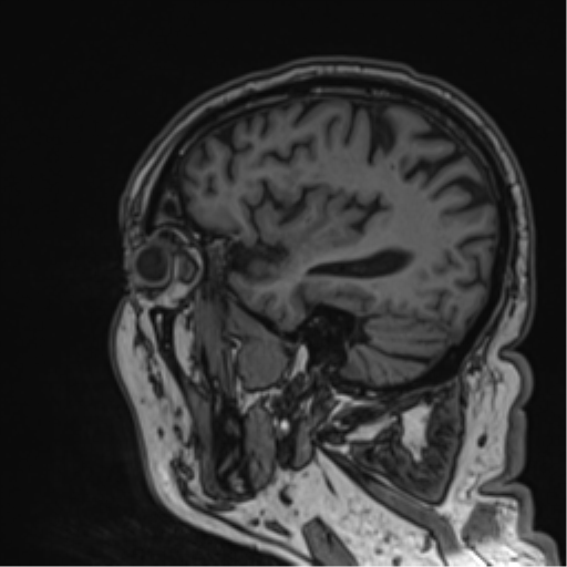 Atypical meningioma (WHO grade II) with brain invasion (Radiopaedia 57767-64729 Sagittal T1 23).png