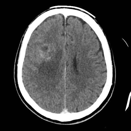 Atypical meningioma (WHO grade II) with osseous invasion (Radiopaedia 53654-59715 Axial C+ delayed 35).png