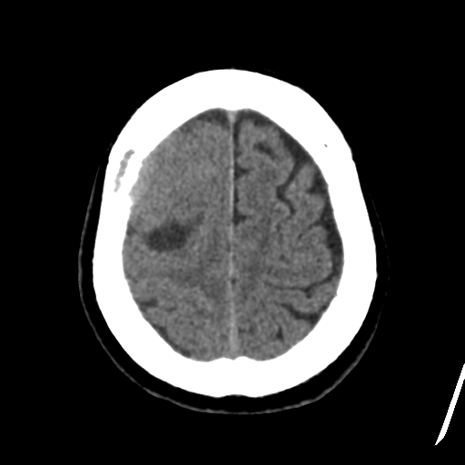 Atypical meningioma (WHO grade II) with osseous invasion (Radiopaedia 53654-59715 Axial non-contrast 44).png