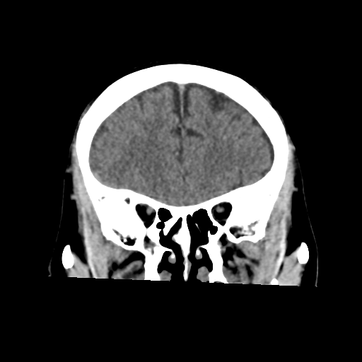 Atypical meningioma (WHO grade II) with osseous invasion (Radiopaedia 53654-59715 Coronal non-contrast 20).png
