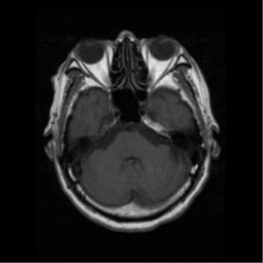 File:Atypical meningioma with skull invasion (Radiopaedia 34357-35648 Axial T1 6).png