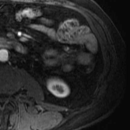 File:Atypical renal cyst on MRI (Radiopaedia 17349-17046 C 28).jpg