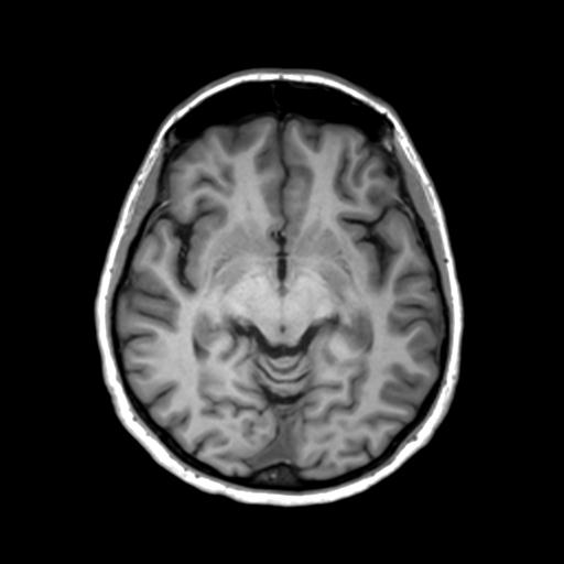 Autoimmune limbic encephalitis (Radiopaedia 30363-31005 T1 Axial 3mm 23).jpg