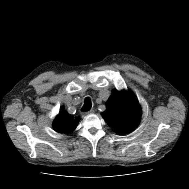 Autosomal dominant polycystic kidney disease (Radiopaedia 27851-28094 Axial non-contrast 7).jpg