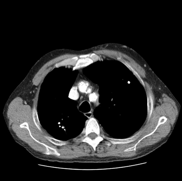 Autosomal dominant polycystic kidney disease (Radiopaedia 27851-28094 B 16).jpg