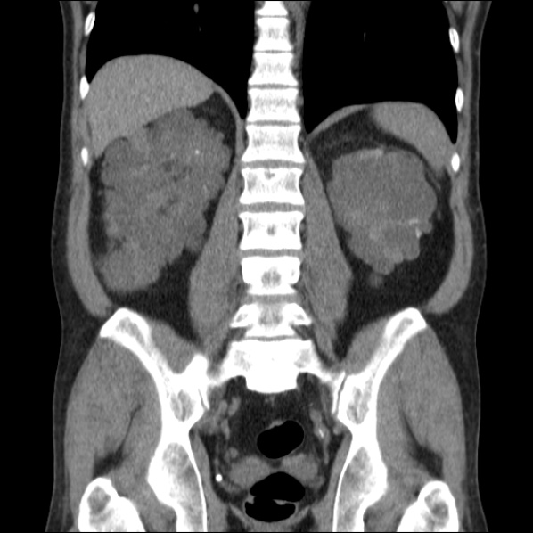 Autosomal dominant polycystic kidney disease (Radiopaedia 36539-38101 C 48).jpg