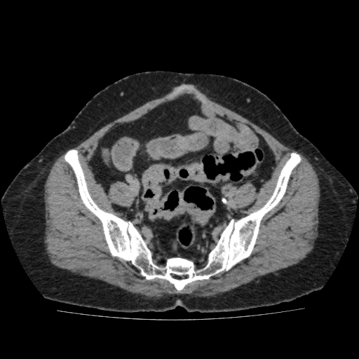 File:Autosomal dominant polycystic kidney disease (Radiopaedia 38189-40194 Axial C+ delayed 46).jpg