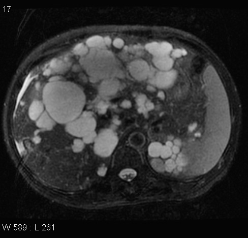 File:Autosomal dominant polycystic kidney disease (Radiopaedia 5202-6969 Axial T2 fat sat 6).jpg