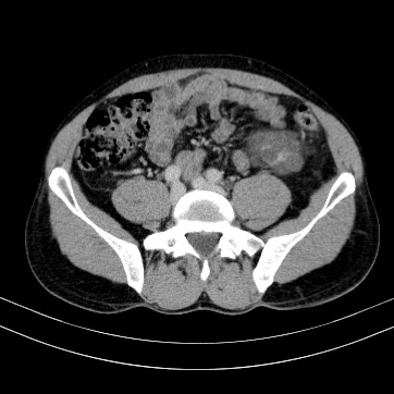 Autosomal dominant polycystic kidney disease (Radiopaedia 66349-75582 B 72).jpg