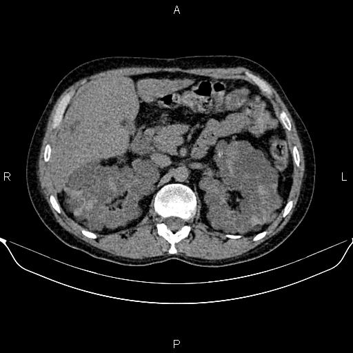 Autosomal dominant polycystic kidney disease (Radiopaedia 87830-104287 Axial non-contrast 20).jpg