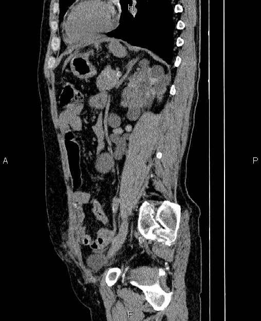 Autosomal dominant polycystic kidney disease (Radiopaedia 87830-104287 C 60).jpg
