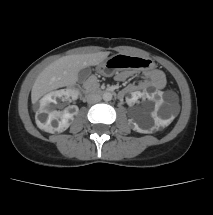 Autosomal dominant polycystic kidney disease - early onset (Radiopaedia 40734-43387 A 38).jpg