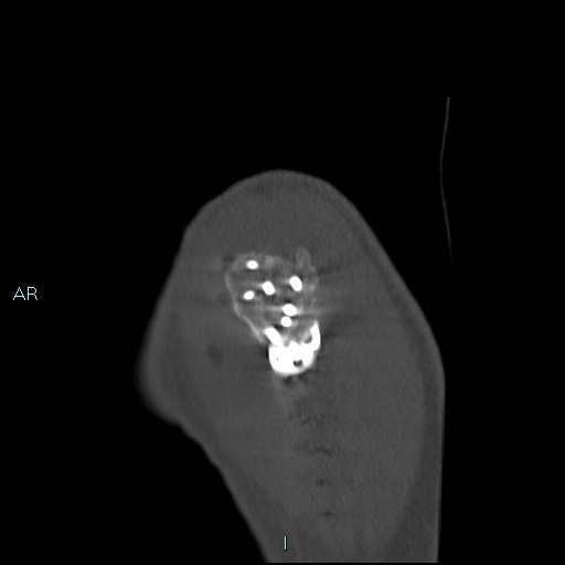 Avascular necrosis after fracture dislocations of the proximal humerus (Radiopaedia 88078-104653 Sagittal bone window 14).jpg