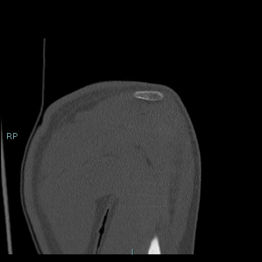 Avascular necrosis after fracture dislocations of the proximal humerus (Radiopaedia 88078-104655 Coronal bone window 47).jpg