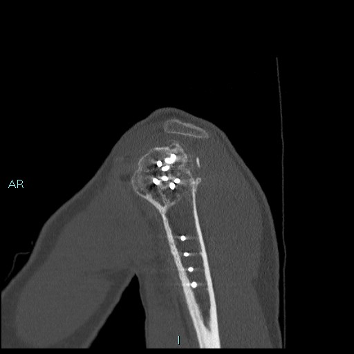 Avascular necrosis after fracture dislocations of the proximal humerus (Radiopaedia 88078-104655 Sagittal bone window 17).jpg