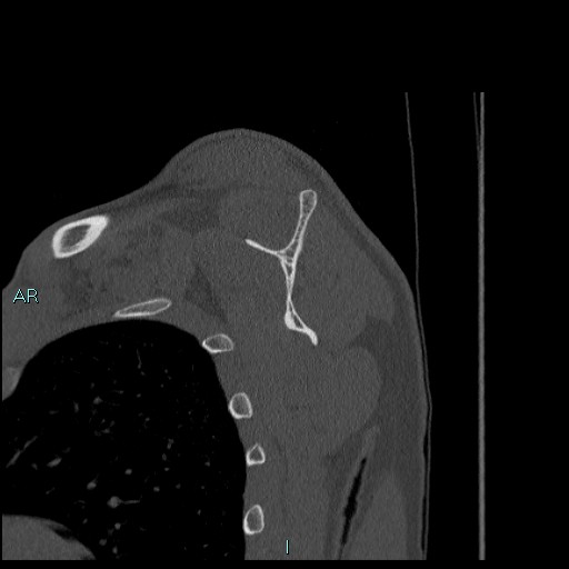 Avascular necrosis after fracture dislocations of the proximal humerus (Radiopaedia 88078-104655 Sagittal bone window 46).jpg