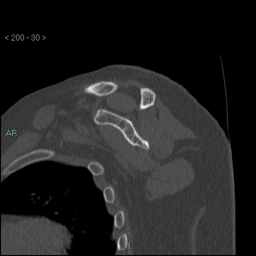Avascular necrosis of the shoulder - Cruess stage I (Radiopaedia 77674-89887 Sagittal bone window 29).jpg