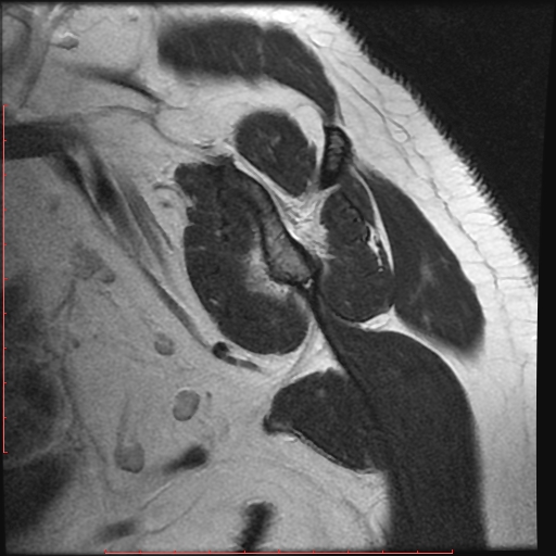 File:Avulsion fracture - greater tuberosity of humerus (Radiopaedia 25457-25703 Sagittal T2 1).jpg