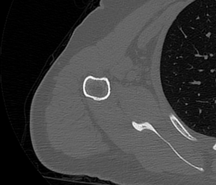 Avulsion fracture - greater tuberosity of humerus (Radiopaedia 71216-81514 Axial bone window 59).jpg
