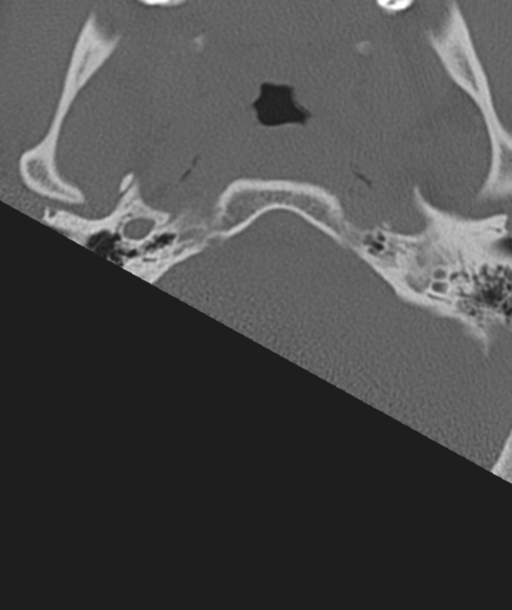 Axis peg fracture (type 3) and atlas lateral mass (type 4) fracture (Radiopaedia 37474-39324 Axial bone window 2).png