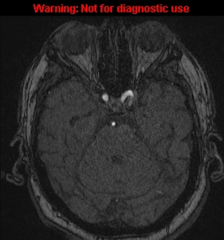 Azygos anterior cerebral artery (Radiopaedia 59325-66677 Axial MRA 51).jpg