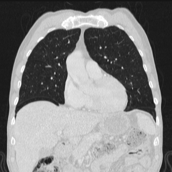 Azygos lobe (Radiopaedia 38259-40275 Coronal lung window 27).jpg