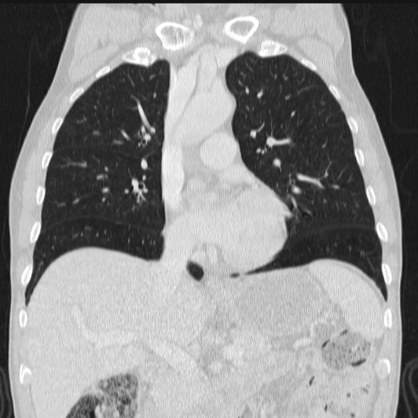 Azygos lobe (Radiopaedia 38259-40275 Coronal lung window 35).jpg
